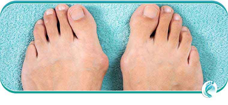 Bunion Specialist Questions and Answers