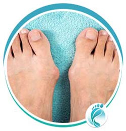 Bunions Treatment in Lyndhurst, OH