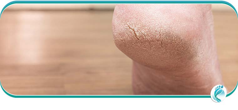 Cracked Heels: Causes & Treatment | Scholl UK