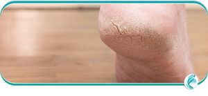 Cracked Heels Treatment Near Me in Lyndhurst, OH Cracked Heels Treatment Near Me in Lyndhurst, OH
