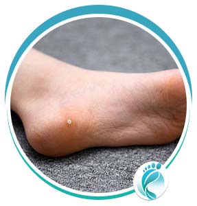 Plantar Warts Treatments in Lyndhurst, OH