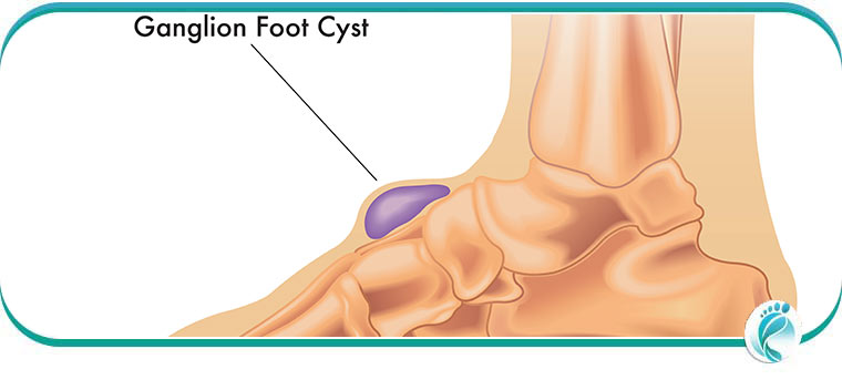 Ganglion Cyst Treatment Specialist Near Me in Lyndhurst, OH Ganglion Cyst Treatment Specialist Near Me in Lyndhurst, OH